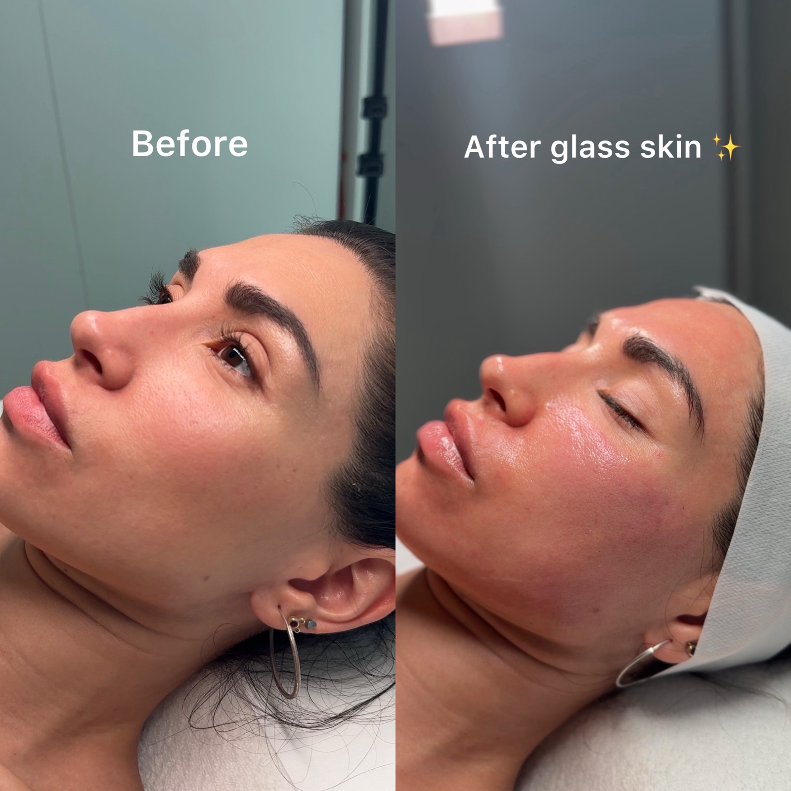 Before and after microneedling with PDRN — glass skin finish